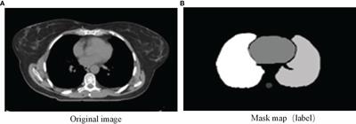 Geometric and Dosimetric Evaluation of the Automatic Delineation of Organs at Risk (OARs) in Non-Small-Cell Lung Cancer Radiotherapy Based on a Modified DenseNet Deep Learning Network